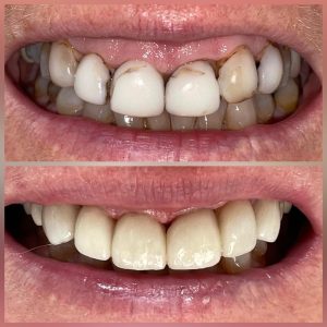 Porcelain Veneers Before and After