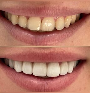 Porcelain Veneers Before and After