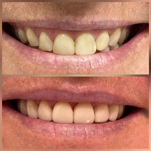 before and after porcelain veneers