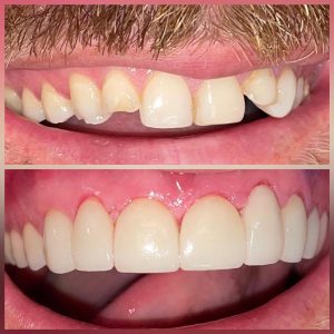 before and after porcelain veneers