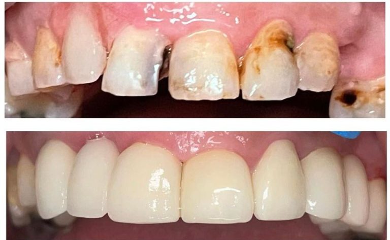 porcelain veneers before and after